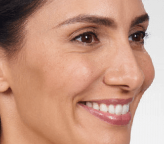 botox injections, Botox and Dysport Injections