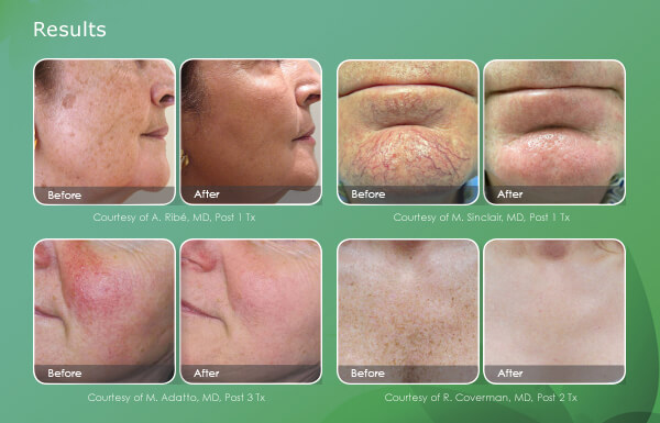 IPL Laser Skin Treatment Before and After
