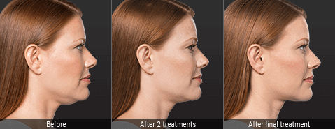KYBELLA® Before and After