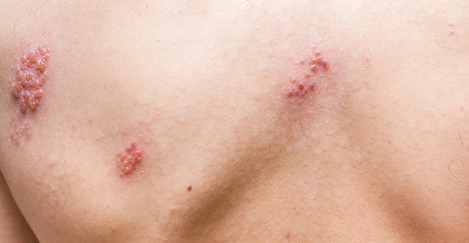 Herpes Zoster (Shingles) Treatment