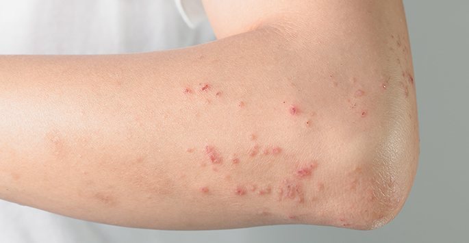 Impetigo Treatment Dermatology Consultants Of South Florida