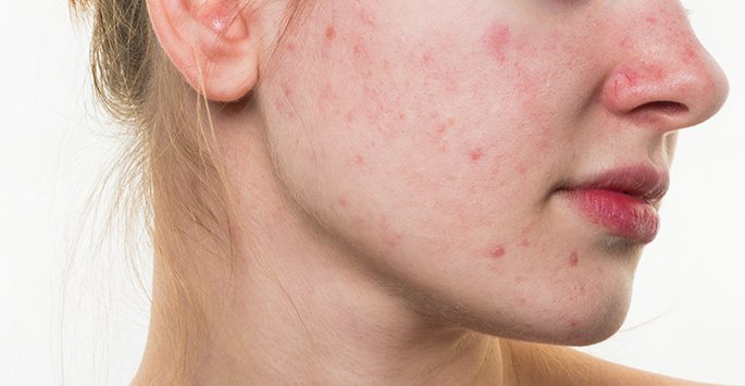 acne rosacea treatment