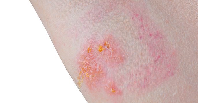 Rashes/Hives, Skin Cancer South Florida