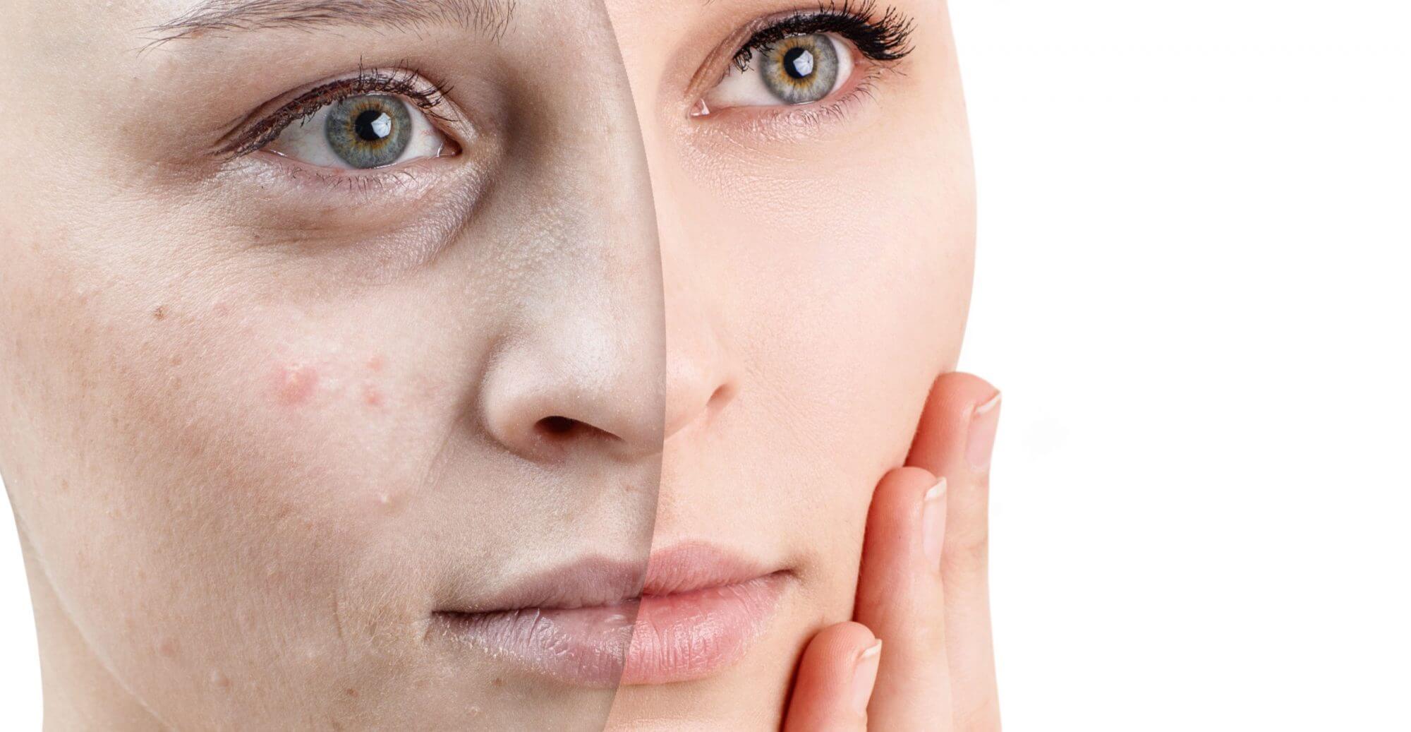Acne Treatment in Coral Springs