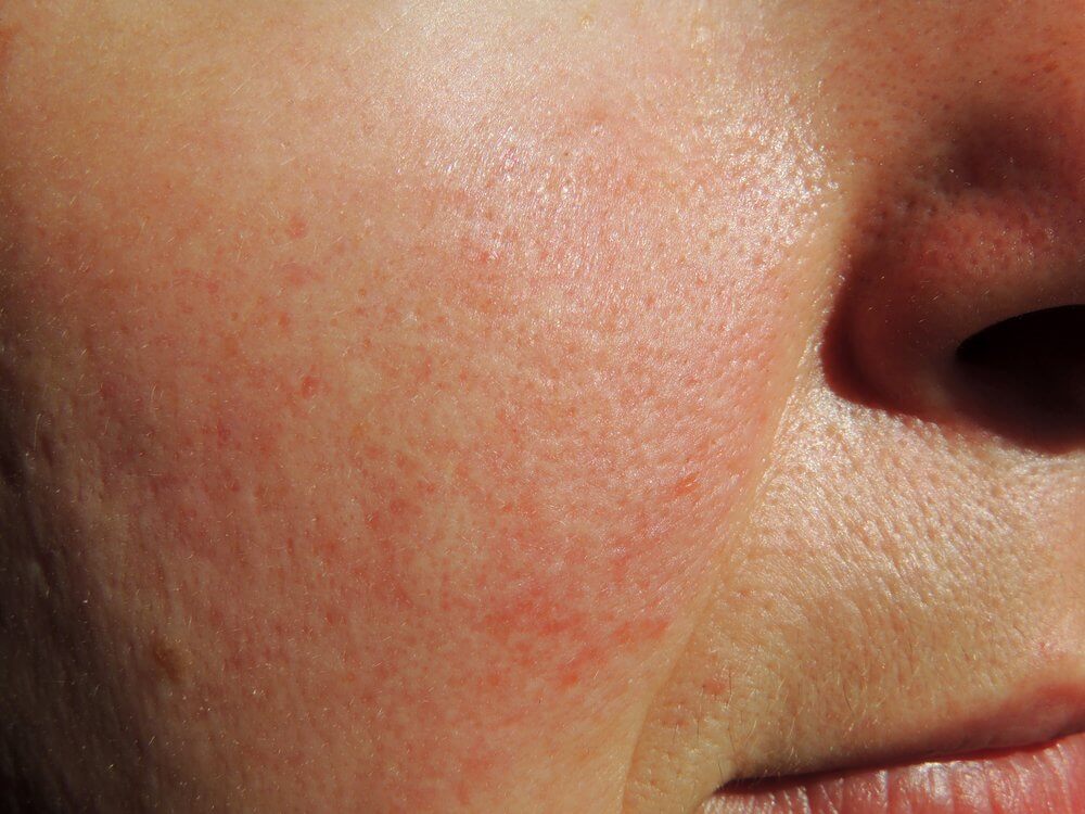 rosacea nose bumps